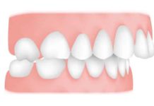 Top 5 Effective Ways to Treat Malocclusion Ways to Treat Malocclusion