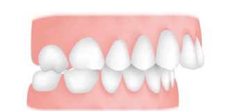 Top 5 Effective Ways to Treat Malocclusion Ways to Treat Malocclusion