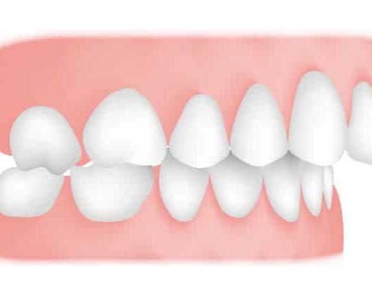 Top 5 Effective Ways to Treat Malocclusion Ways to Treat Malocclusion