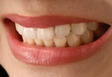 Porcelain veneers: A remedy for the perfect smile for you porcelain veneers