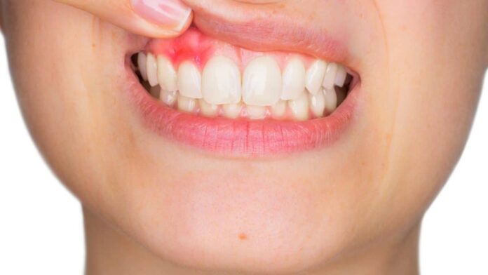 Dental Abscess