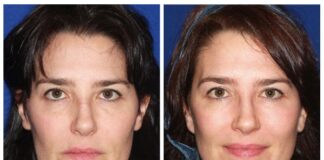 The Big Advantages Of A Mini Facelift Mini Facelift