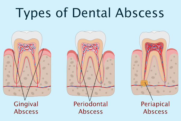 types of Abscess