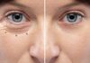 What Happens After Oculoplastic Surgery? Oculoplastic Surgery