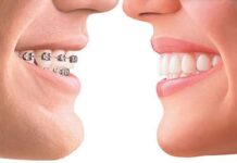 What’s Covered Under Orthodontics? What’s Covered Under Orthodontics