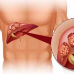 Who Can Use an At-home Liver Test?